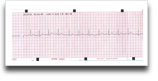 EKG